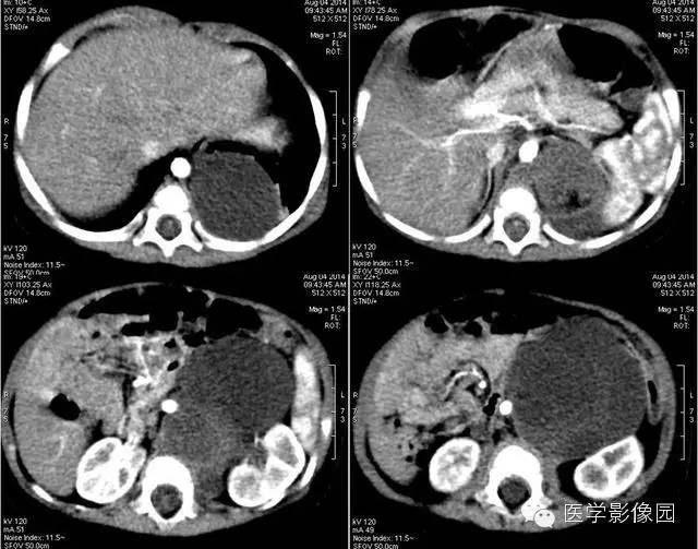 【病例】腹膜后畸胎瘤1例CT影像表现