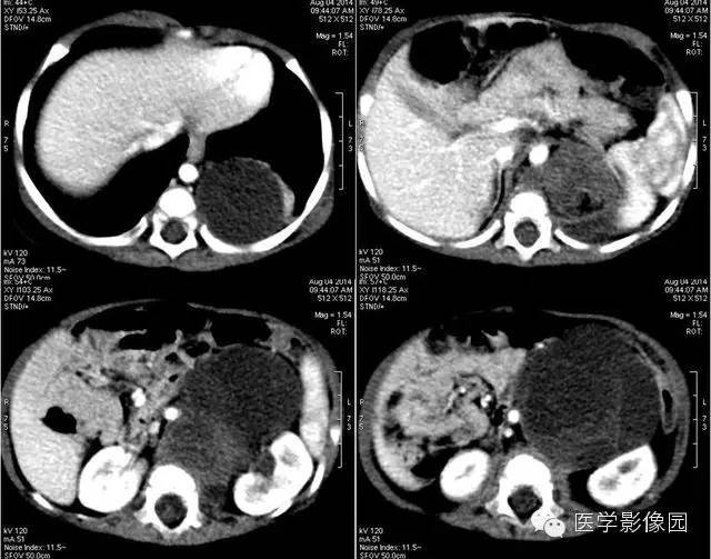 【病例】腹膜后畸胎瘤1例CT影像表现