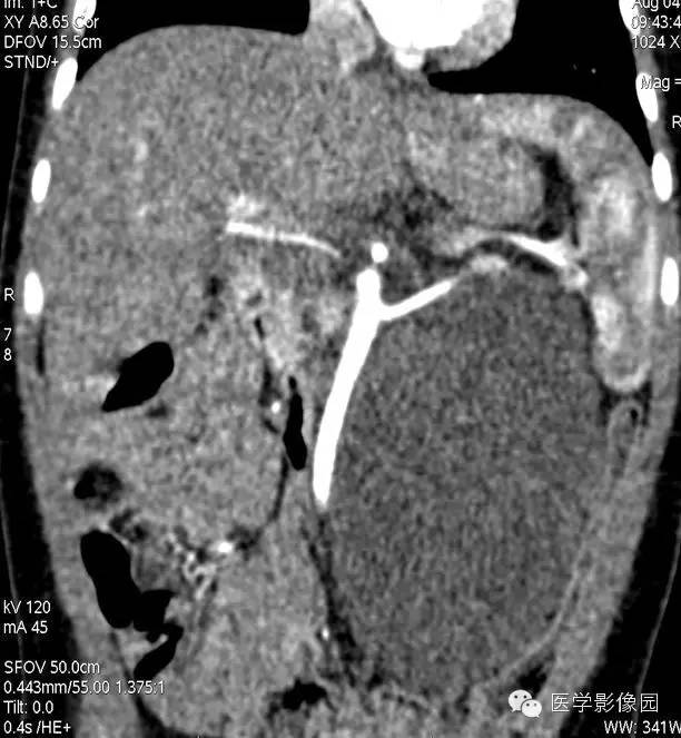 【病例】腹膜后畸胎瘤1例CT影像表现