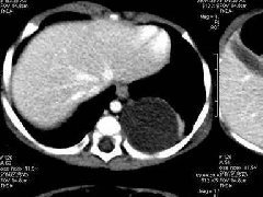 <b>腹膜后畸胎瘤1例CT影像表现</b>