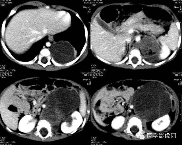 【病例】腹膜后畸胎瘤1例CT影像表现