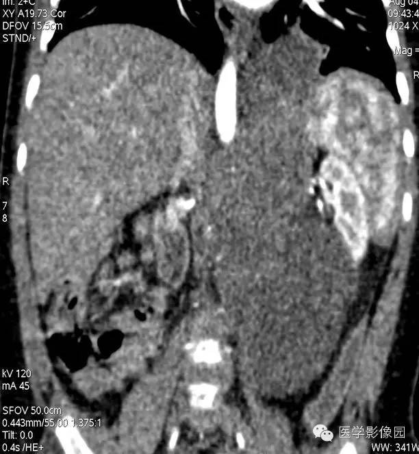 【病例】腹膜后畸胎瘤1例CT影像表现
