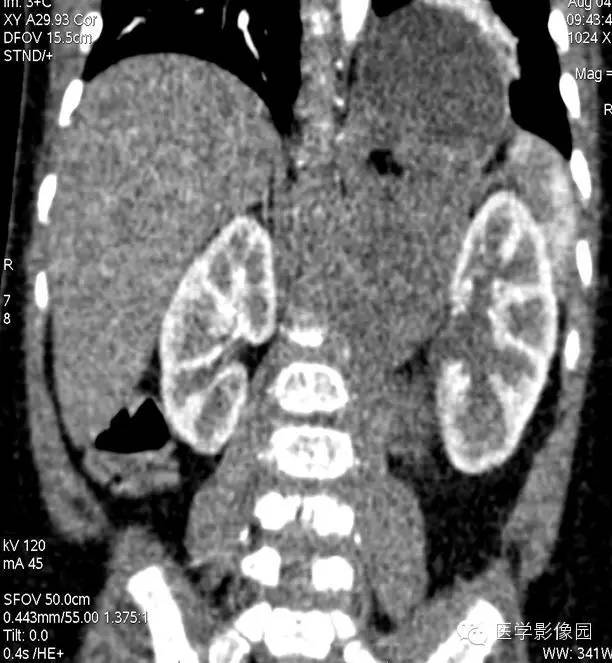 【病例】腹膜后畸胎瘤1例CT影像表现
