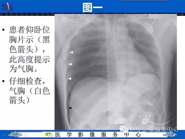 【影像征象】深沟征——气胸间接征象