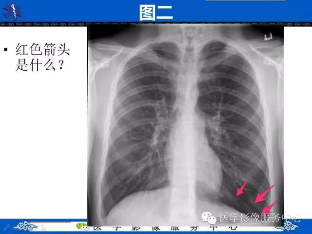 【影像征象】深沟征——气胸间接征象