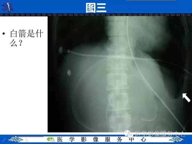 【影像征象】深沟征——气胸间接征象