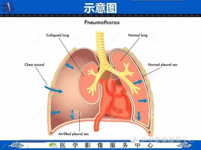 【影像征象】深沟征——气胸间接征象