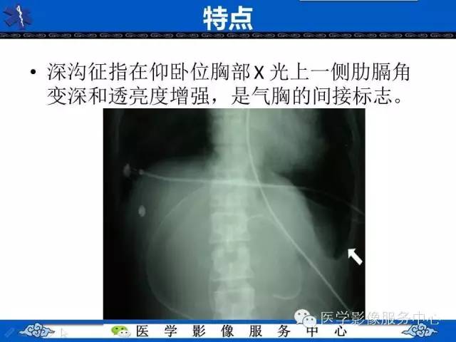 【影像征象】深沟征——气胸间接征象