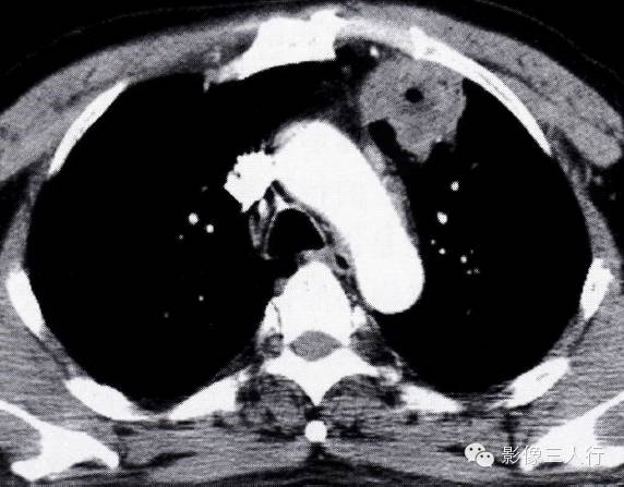 “纵隔旁肺脓肿”的 “四大”  CT表现，你知道如果鉴别诊断吗？