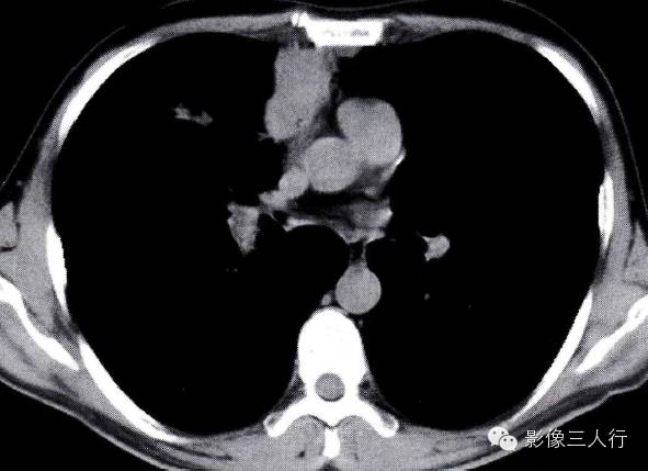 “纵隔旁肺脓肿”的 “四大”  CT表现，你知道如果鉴别诊断吗？