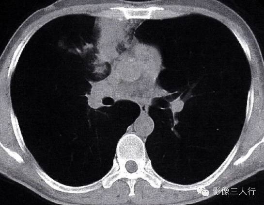 “纵隔旁肺脓肿”的 “四大”  CT表现，你知道如果鉴别诊断吗？