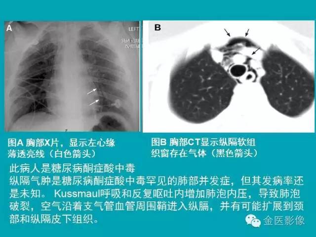 【PPT】纵隔气肿的影像学表现