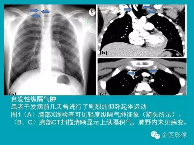 【PPT】纵隔气肿的影像学表现