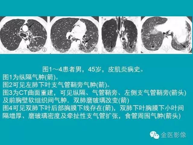 【PPT】纵隔气肿的影像学表现