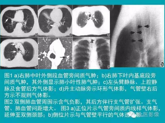 【PPT】纵隔气肿的影像学表现