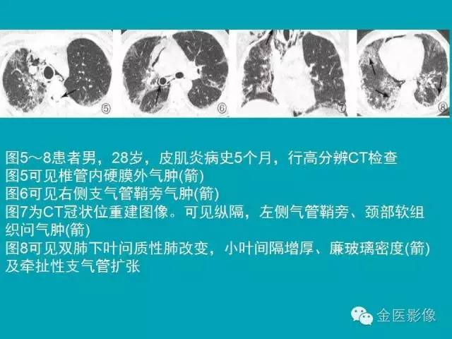 【PPT】纵隔气肿的影像学表现