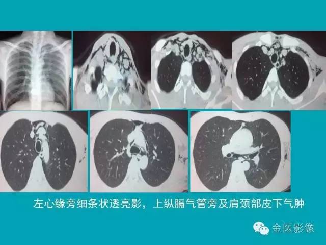【PPT】纵隔气肿的影像学表现