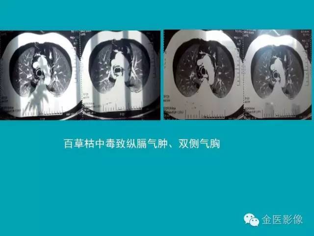 【PPT】纵隔气肿的影像学表现