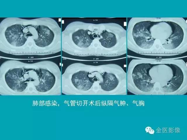 【PPT】纵隔气肿的影像学表现