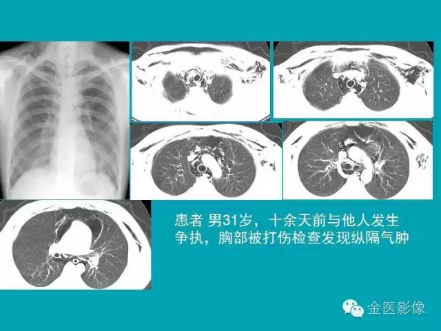 【PPT】纵隔气肿的影像学表现