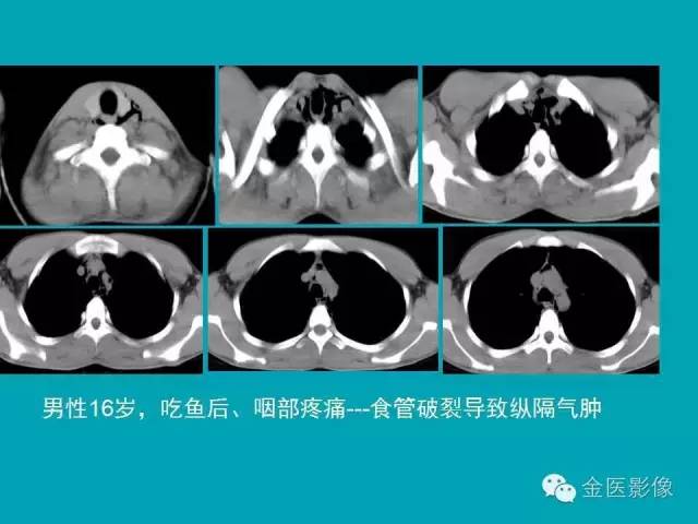 【PPT】纵隔气肿的影像学表现