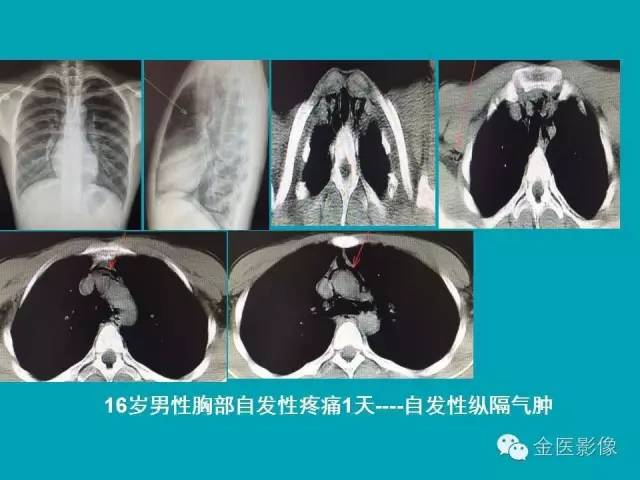 【PPT】纵隔气肿的影像学表现