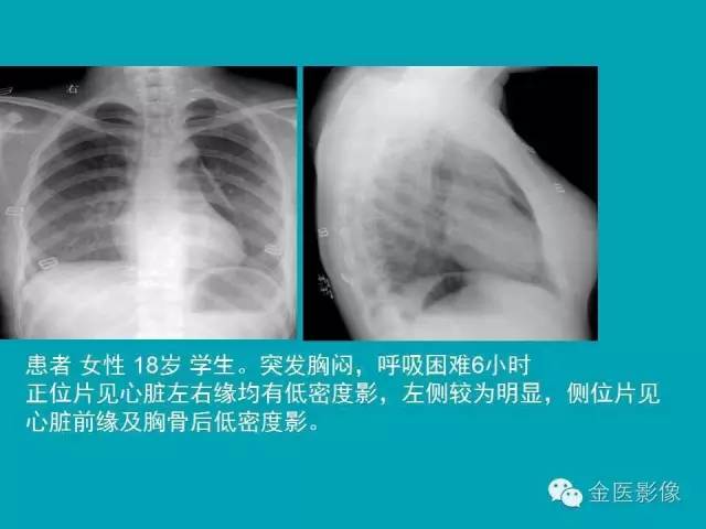 【PPT】纵隔气肿的影像学表现