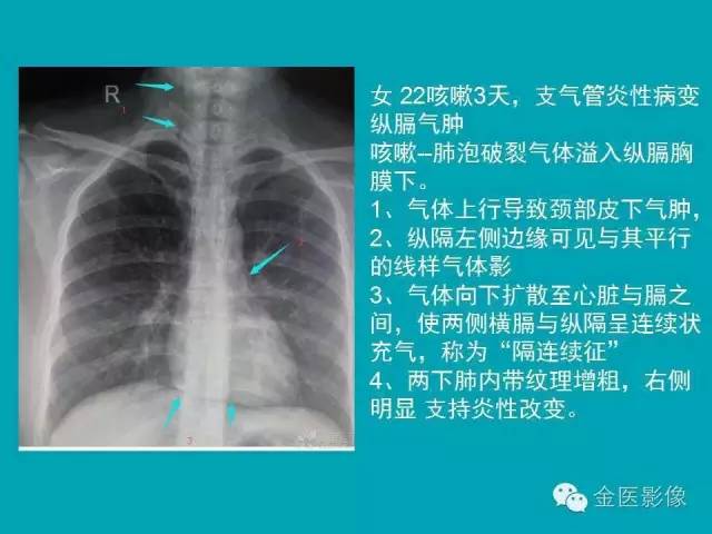 【PPT】纵隔气肿的影像学表现