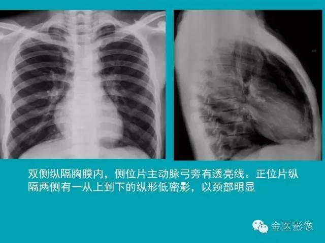 【PPT】纵隔气肿的影像学表现