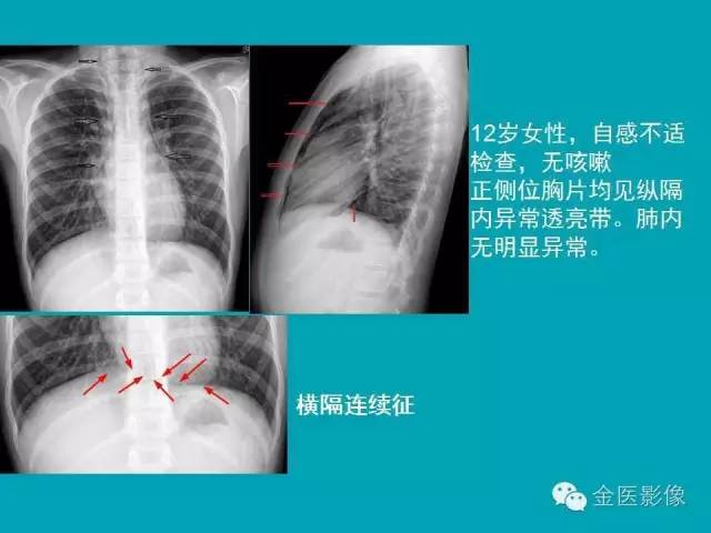 【PPT】纵隔气肿的影像学表现