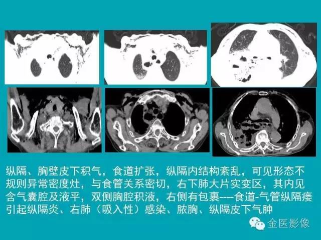 【PPT】纵隔气肿的影像学表现