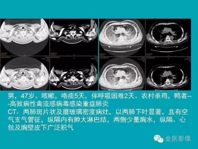 【PPT】纵隔气肿的影像学表现