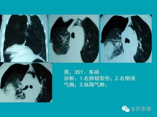 【PPT】纵隔气肿的影像学表现