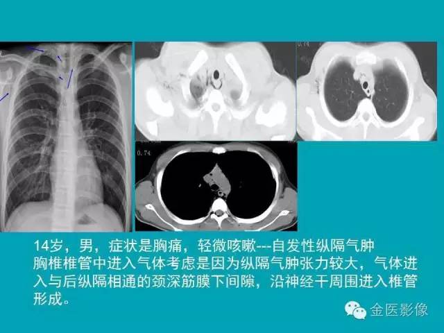【PPT】纵隔气肿的影像学表现