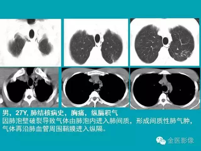 【PPT】纵隔气肿的影像学表现