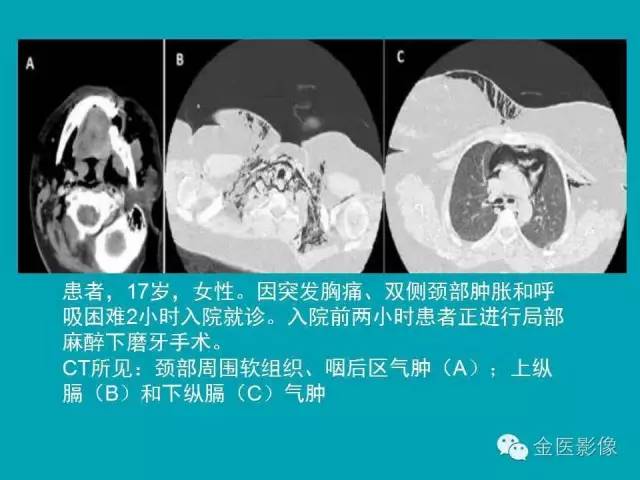 【PPT】纵隔气肿的影像学表现