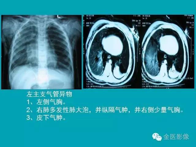 【PPT】纵隔气肿的影像学表现