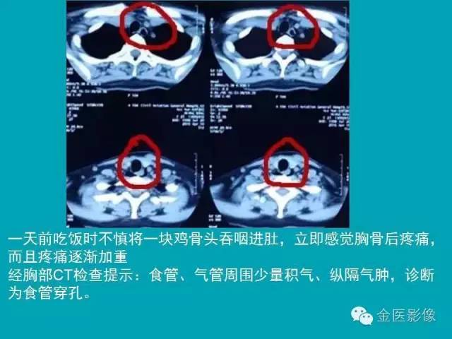 【PPT】纵隔气肿的影像学表现