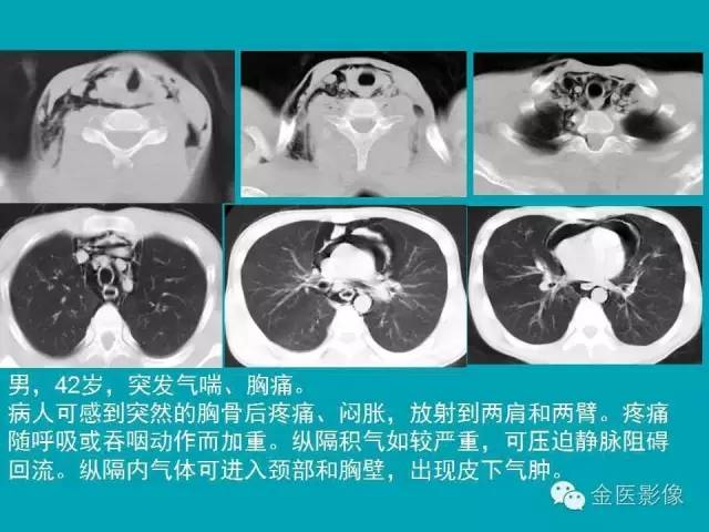 【PPT】纵隔气肿的影像学表现