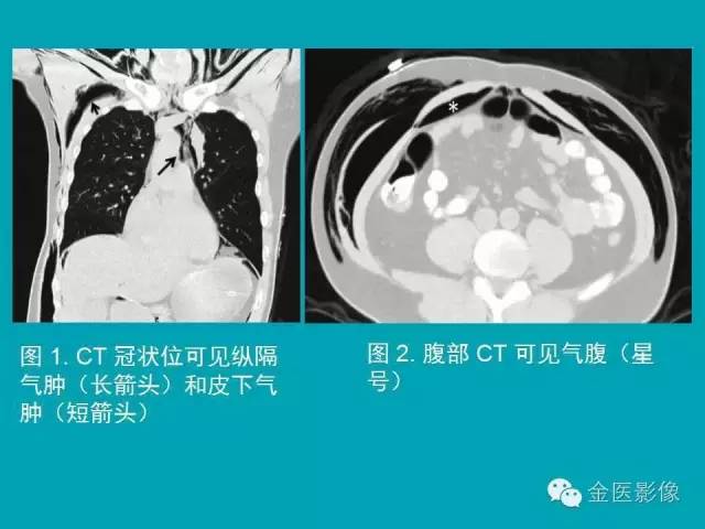 【PPT】纵隔气肿的影像学表现