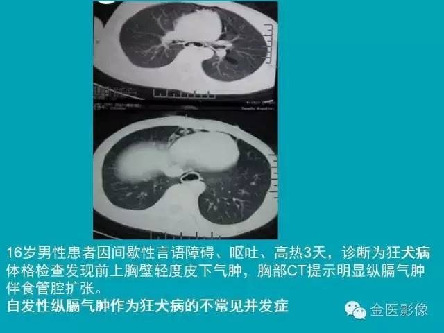 【PPT】纵隔气肿的影像学表现