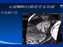 心脏MRI简介及实例分析