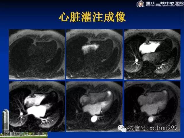 【PPT】心脏MRI简介及实例分析