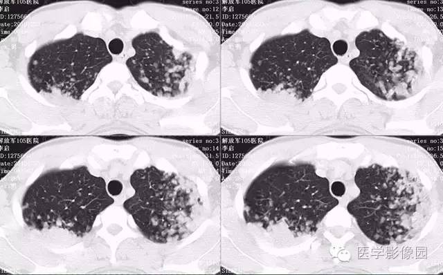 【病例】弥漫性肺泡细胞癌1例CT影像表现
