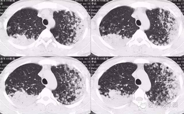 【病例】弥漫性肺泡细胞癌1例CT影像表现