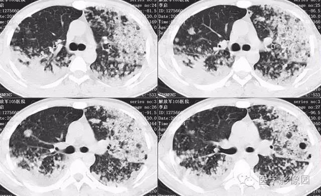 【病例】弥漫性肺泡细胞癌1例CT影像表现