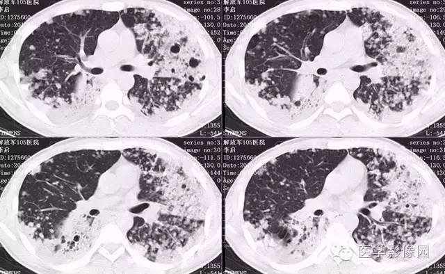 【病例】弥漫性肺泡细胞癌1例CT影像表现