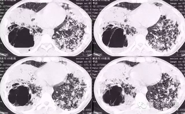【病例】弥漫性肺泡细胞癌1例CT影像表现