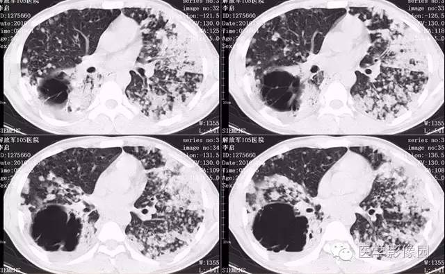 【病例】弥漫性肺泡细胞癌1例CT影像表现