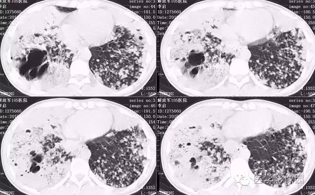 【病例】弥漫性肺泡细胞癌1例CT影像表现